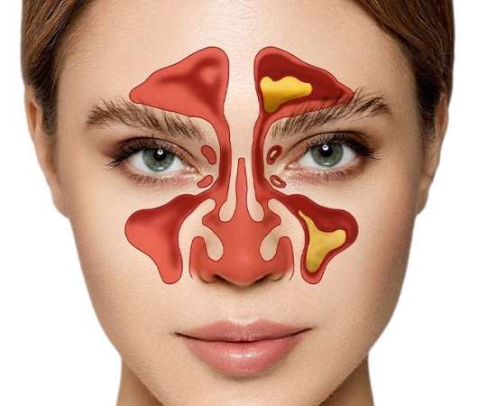 پاورپوینت بیماری سینوزیت و روش های کنترل آن